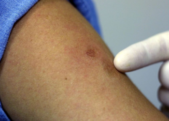 Caso sospechoso de viruela del mono en Nuevo Laredo