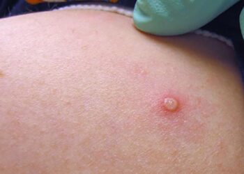 Reportan en Cameron 303 casos de covid en un día