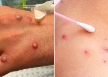 De Zumpango y Chimalhuacán, los hombres detectados con viruela símica