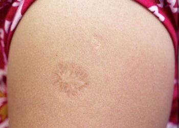 Personas vacunadas hasta 1990 podrían ser inmunes a la viruela del mono