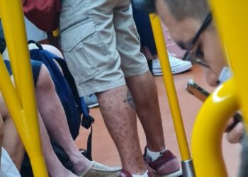 Detectan primeros casos de viruela del mono en Michoacán y BCS