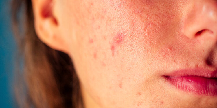 post-acne, scars and red festering pimples on the face of a young woman. concept of skin problems and harmonic failure.