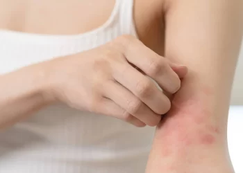 Identifican una bacteria como causante principal de la picazón en la dermatitis atópica