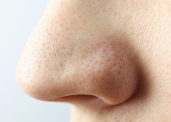 Hurgarse la nariz podría aumentar riesgo de Alzheimer