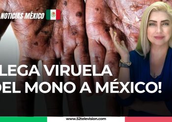 Llega viruela del mono a México!
