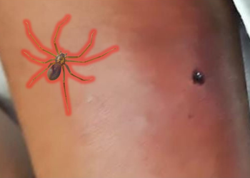 Registran caso de picadura de Araña Violinista en Matamoros