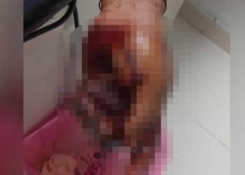 Hombre termina en el hospital con graves heridas tras ser atacado a machetazos
