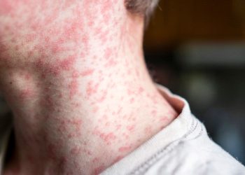 Brote de Sarampión en Texas se Expande Rápidamente