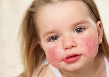 Dermatitis atópica infantil: un impacto que va más allá de la piel