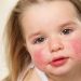 Dermatitis atópica infantil: un impacto que va más allá de la piel
