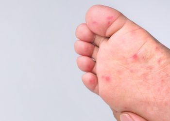 Enfermedad de boca-mano-pie no representa gravedad, pero Salud pide reforzar la prevención