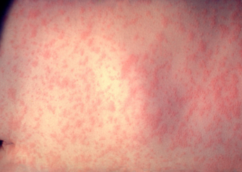 Nuevo León acumula 49 casos de sarampión en medio de brote nacional