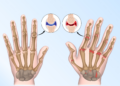 Ten cuidado con la artritis