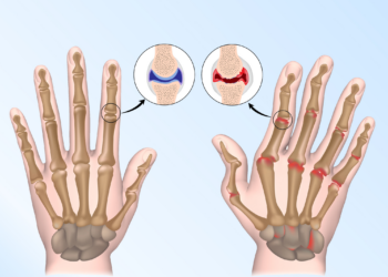 Ten cuidado con la artritis