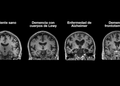 Investigadores mexicanos descubren cómo la diabetes afecta a la aparición del Alzheimer