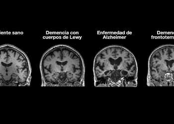 Investigadores mexicanos descubren cómo la diabetes afecta a la aparición del Alzheimer