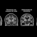 Investigadores mexicanos descubren cómo la diabetes afecta a la aparición del Alzheimer